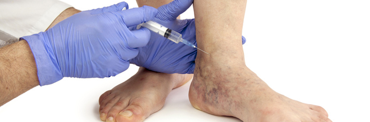 Venous insufficiency complication: What are the ...